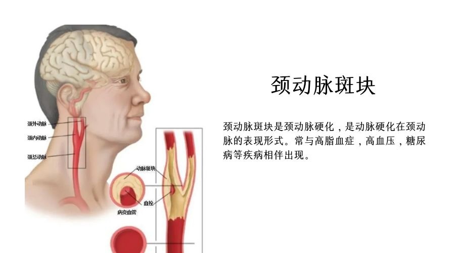 易愛(ài)科普｜成年人1/3都存在的頸動(dòng)脈斑塊究竟是什么？